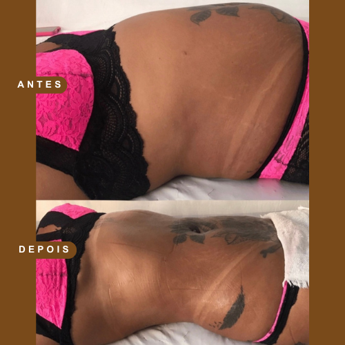 Resultado Lipo Manual 1